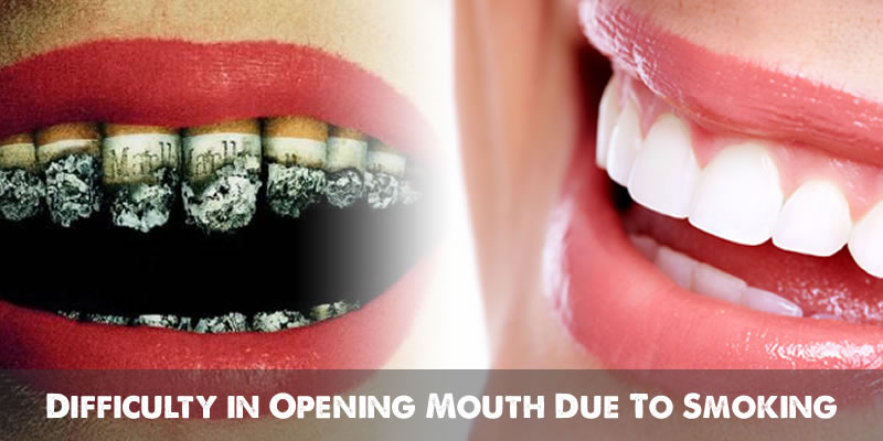 Difficulty in Opening Mouth Due To Smoking