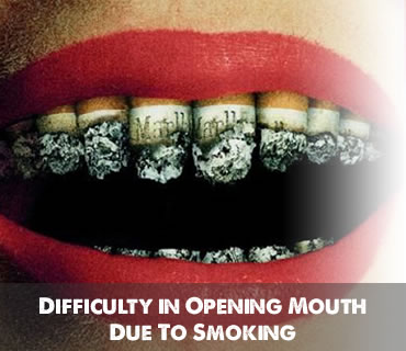 Difficulty in Opening Mouth Due To Smoking